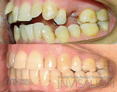 master-invisalign-programa-5.jpg